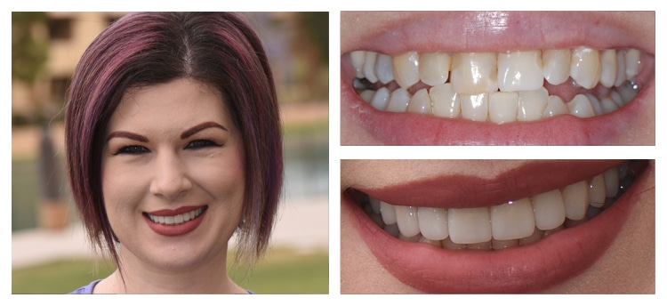 Dentist Chandler AZ Before and After 03