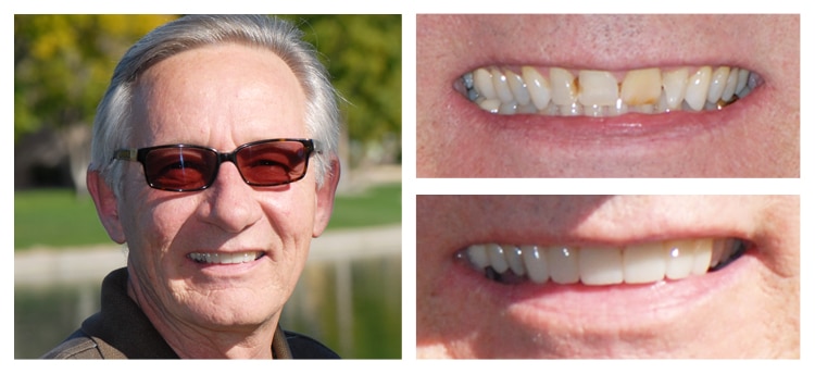 Dentist Chandler AZ Before and After 04