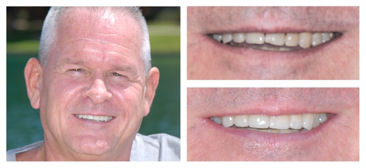 Dentist Chandler AZ Before and After 07