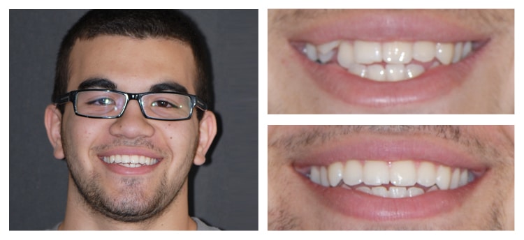 Dentist Chandler AZ Before and After 09