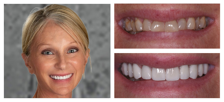 Dentist Chandler AZ Before and After