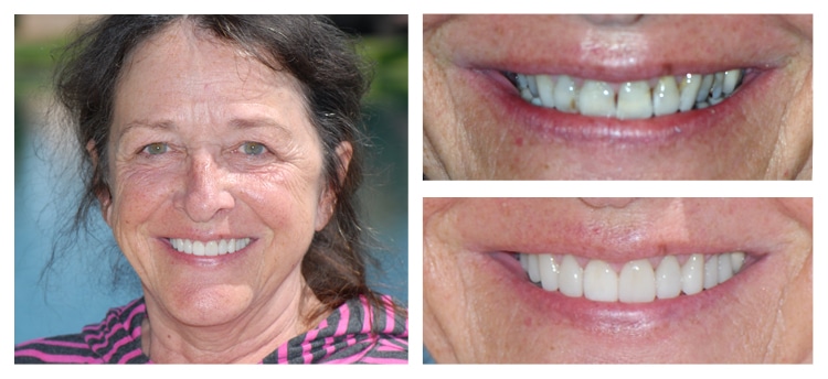 Dentist Chandler AZ Before and After