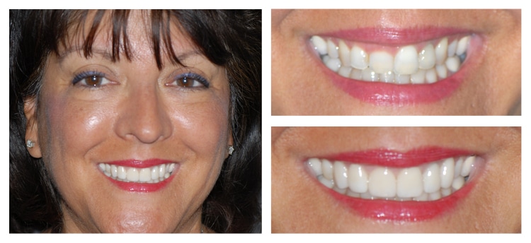 Dentist Chandler AZ Before and After 16