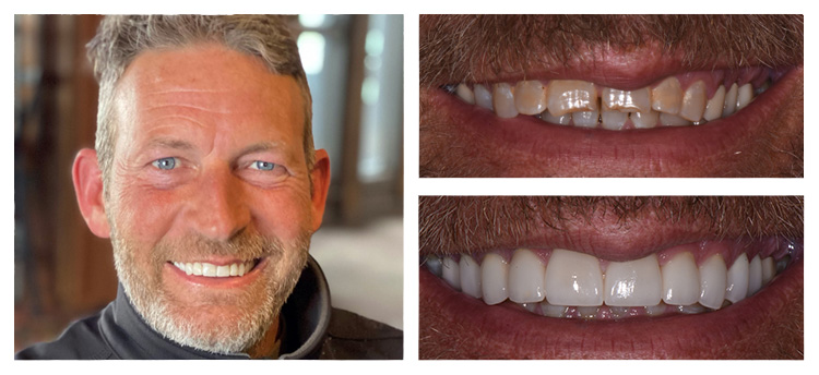 Dentist Chandler AZ Before and After 20