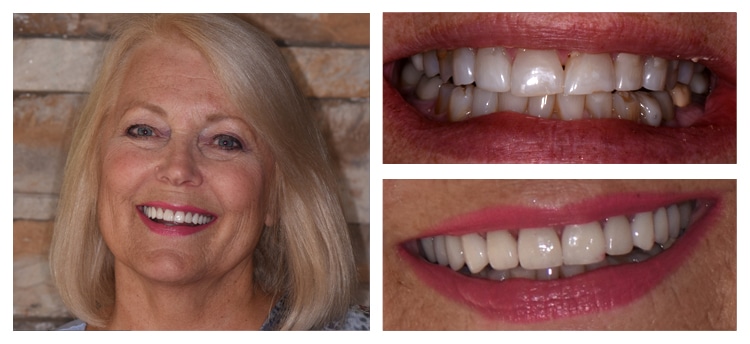Dentist Chandler AZ Before and After 3