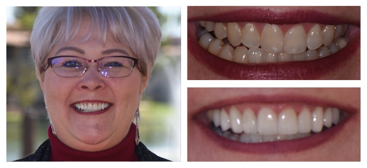 Dentist Chandler AZ Before and After 4