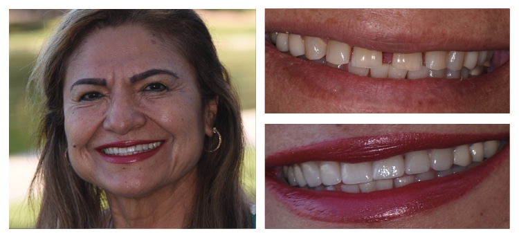 Dentist Chandler AZ Before and After 5