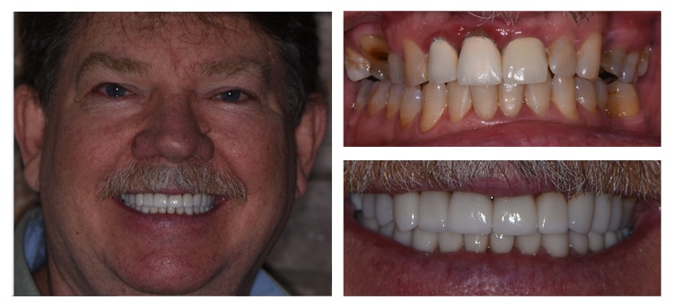 Dentist Chandler AZ Before and After 7