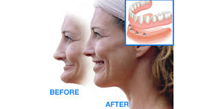 Dentist Chandler AZ Before and After All Four