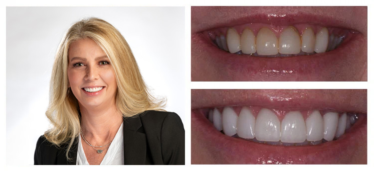 Dentist Chandler AZ Before and After Suzie