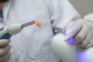 Dentist Chandler AZ Composite Filling