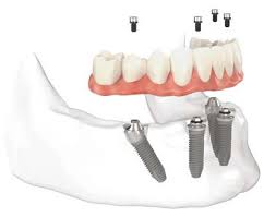 Dentist Chandler AZ Implant Teeth Example
