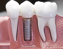 Dentist Chandler AZ Implant