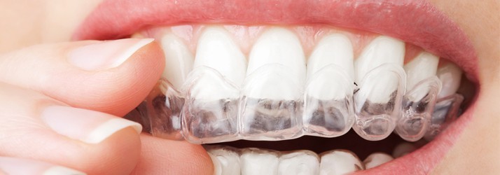 Dentist Chandler AZ Invvisalign