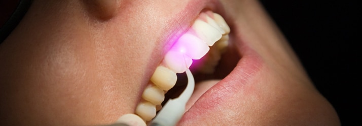 Dentist Chandler AZ Laser Gum Therapy