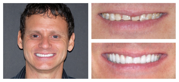 Dentist Chandler AZ Before and After