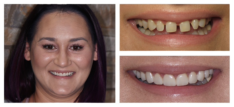 Dentist Chandler AZ Smile Gallery Before And After Smile Gallery
