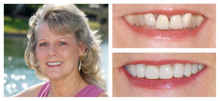 Dentist Chandler AZ Smile Gallery Before And After Smile Gallery