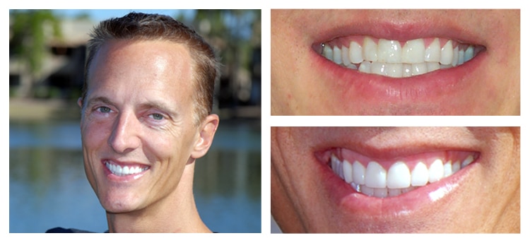 Dentist Chandler AZ Smile Gallery Before And After Smile Gallery