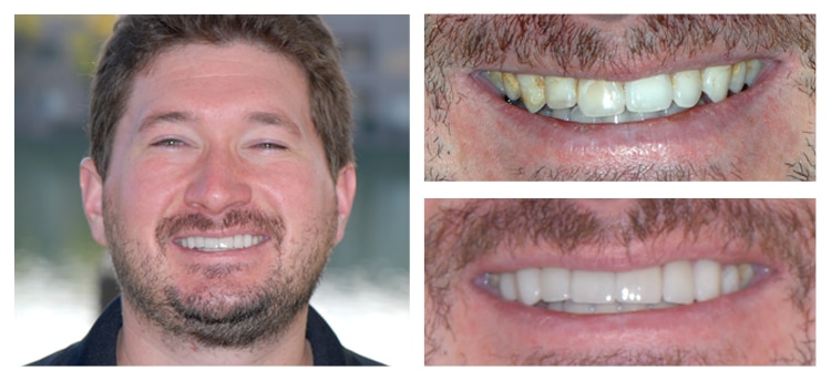 Dentist Chandler AZ Smile Gallery Before And After Smile Gallery