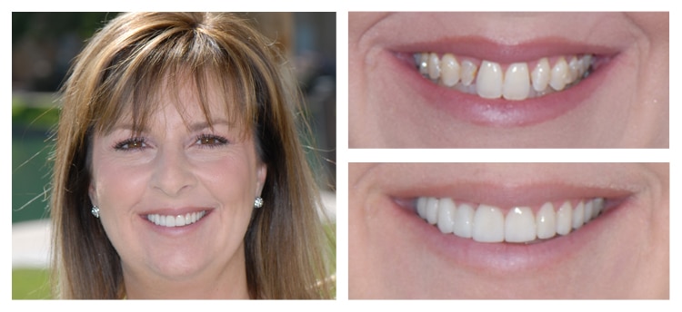 Dentist Chandler AZ Smile Gallery Before And After Smile Gallery
